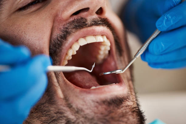 Best Emergency Dental Care for Broken or Chipped Teeth in Englewood, FL